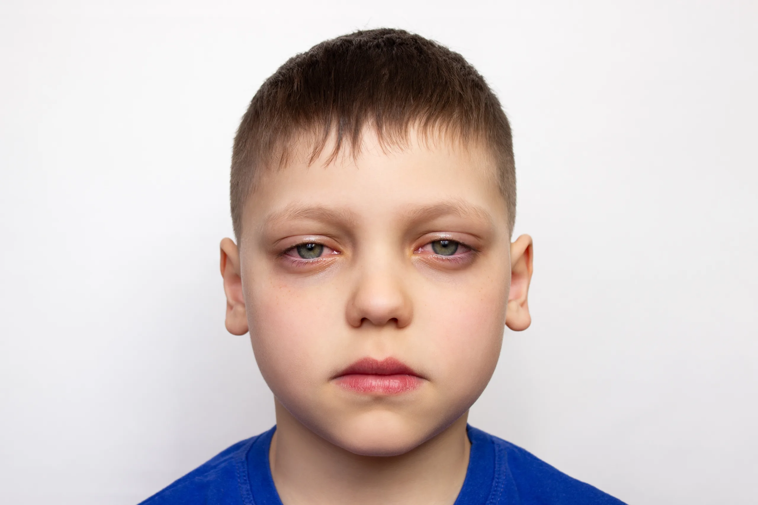 Close Up,Portrait,Of,A,Child,With,Red,Puffy,Eyes,,Isolated