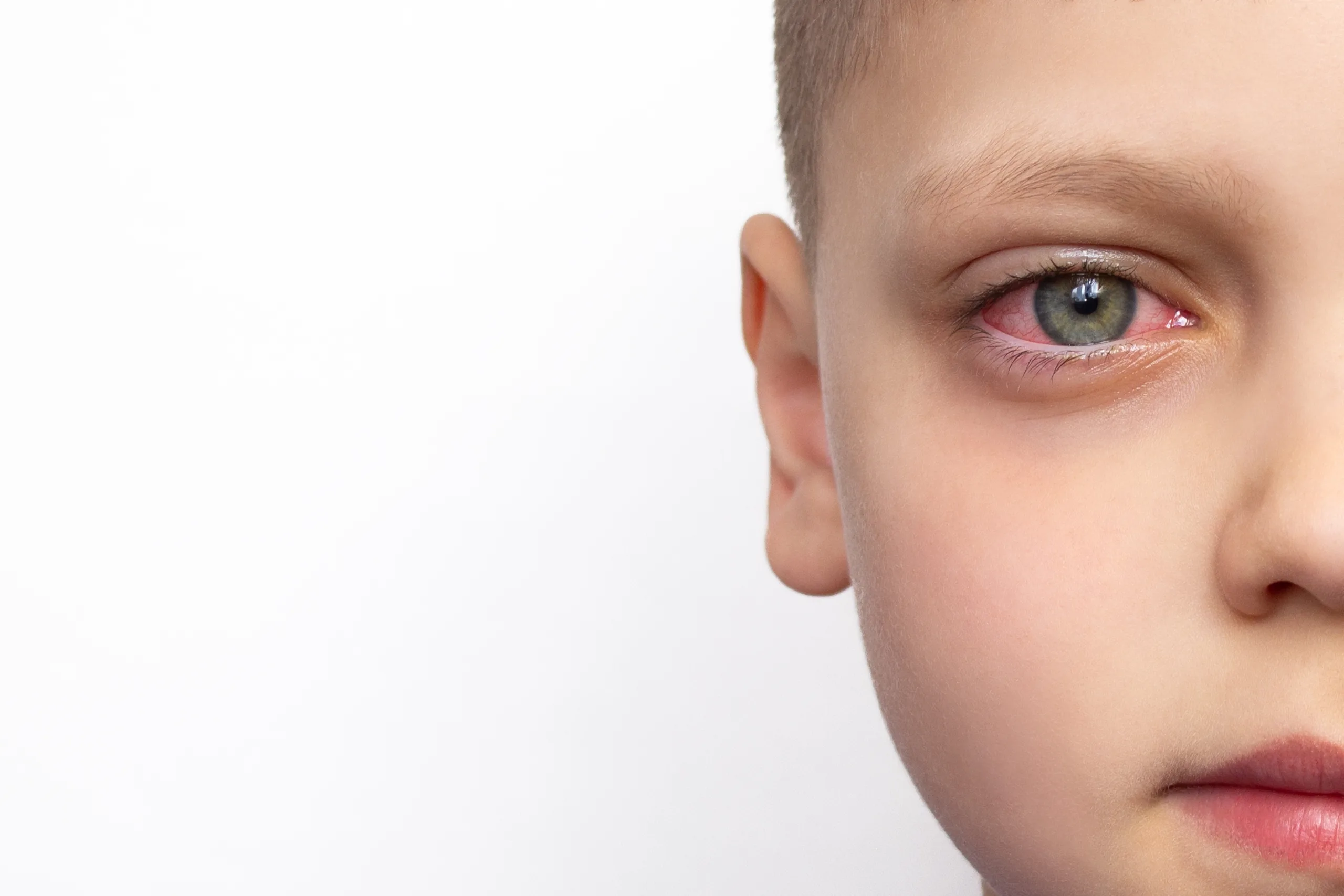 Closeup,Of,A,Child's,Face,With,A,Red,Eye,,Isolated